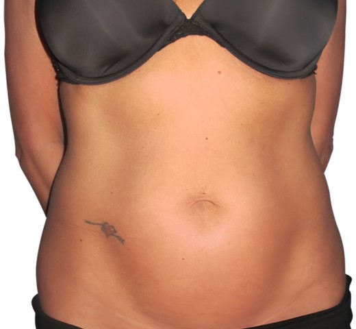 Remodelación Corporal venus legacy-despues