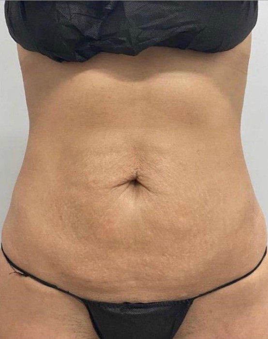 Resultados_despues_Emsculpt NEO_Miami con Nancy_Torres